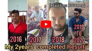 2years Completed Hair Transplant Result | My Hair Transplant Journey| Best Tamil Hair Transplant