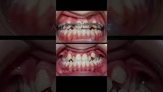 Underbite Braces - Niềng răng cắn ngược