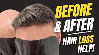 Before & After | Hair System | Hair Loss To Full Hair In Minutes | Hair Replacement System Men UK