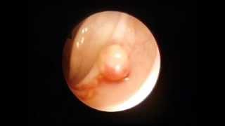 Colonoscopy - colon polyp