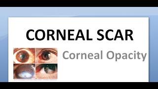 Ophthalmology 144 Acquired Corneal Scar Opacity Type Nebular Macular Leucoma Anterior Staphyloma