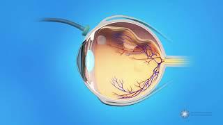 Vitrectomy Surgery for Detached Retina