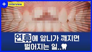 갑작스럽게 앞니가 깨져 연휴에 치과를 찾던 20대 앞니 임플란트 환자의 후기 인터뷰!!