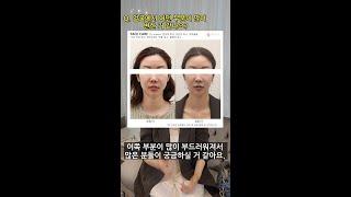 미본 6회차 관리 후 인터뷰