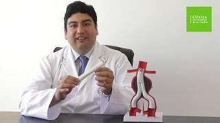 ¿Qué es un Aneurisma de Aorta Abdominal?