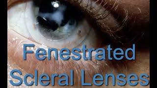 Fenestrated Scleral lenses Webinar 9/22/2020