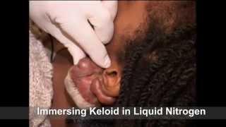 Keloid of Ear treated with Cryotherapy