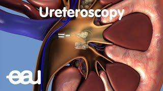 Removal of kidney stones: URS