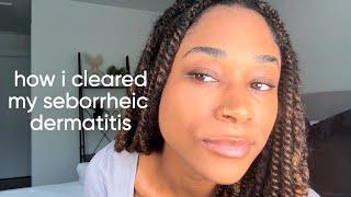 I cleared my seborrheic dermatitis naturally.....