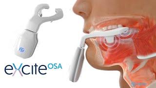 eXciteOSA - Daytime Treatment for Mild OSA and Snoring (FDA Approved Sleep Therapy Device)