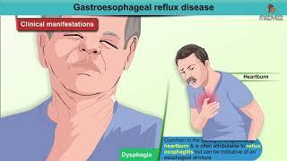 Gastroesophageal reflux disease Animation / GERD : Etiology , Diagnosis , Pathology , Treatment