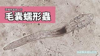 酒糟患者臉上的蠕形蟲 (蠕形蟎；demodex)