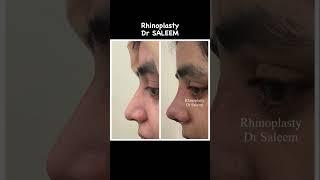 Rhinoplasty surgery in Pakistan, before & after