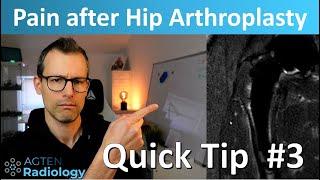 Pain after hip arthroplasty on MRI -  a subtle finding. MSKrad quick tip #3 SHORTS