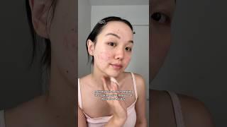 At least my skin can breathe again  #acne #relatable #clearskin #skincare