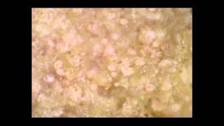 Scabies mites on skin crust