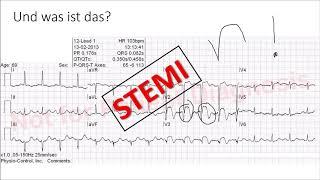 Infarkt im EKG (STEMI, NSTEMI, Sgarbossa Kriterien, Wellens Syndrom...)