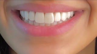 ღ your teeth are literally perfect! ~ veneers procedure 