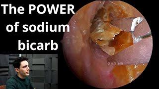 Sodium Bicarbonate Drops VS Earwax & Dead Skin