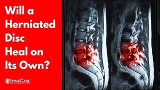 Will a Herniated Disc Heal on Its Own? (SURPRISING ANSWER)