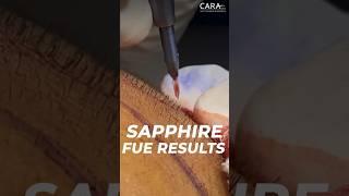 Sapphire Fue Hair Transplant Results .