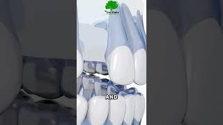 Dental Implant Process  #shorts