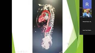 Echocardiography Conference (Contained Aortic Rupture)