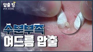 [압출킹] 39. 겨울철 수분부족 여드름 압출 ASMR 시원함 주의!