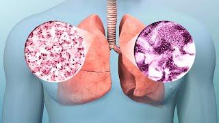 Lung Cancer: Early Diagnosis, Treatment