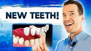 New Front Teeth | Dental Crowns and Veneers