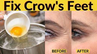 Home remedy to get rid of crow's feet around eyes naturally without botox