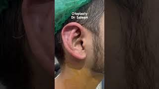 Otoplasty surgery in Pakistan, lahore by dr Saleem. #otoplasty #otoplastybeforeandafter