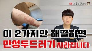 이 2가지만 해결하면 지긋지긋한 만성두드러기  치료할 수 있습니다.