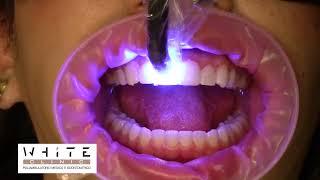 Faccette estetiche dentali - White Clinic