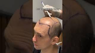 Hair Transplant in Turkey | Hair Transplant Process #hairtransplant