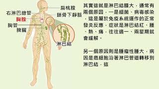 注意！腫大的淋巴結若有這三種病徵　快點就醫檢查