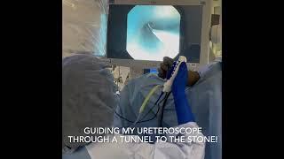 Ureteroscopy with Laser Lithotripsy |  Treating Kidney Stones | Real Procedure Footage