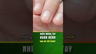 Nhìn móng tay đoán bệnh - Bạn đã thử chưa? - KHOẺ TỰ NHIÊN