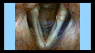 Sulcus Vocalis Causing Severe Hoarse Breathy Voice