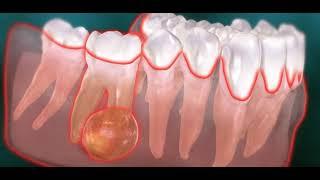 Abcès endodontique dentaire kyste