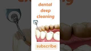 Dental Deep Teeth Cleaning Procedure before and after with heavy tartar 3d animated video |dentist