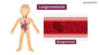 Was ist eine Lungenembolie?