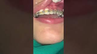 Removing brackets #umairtoothfairy #dentist #satisfying #umairazeem #shorts @Umairazeem8553