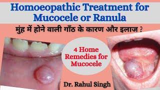 How To Treat Mucocele? होंठ की गाँठ का इलाज और कारण Homeopathic Medicine for Oral Mucocele & Ranula