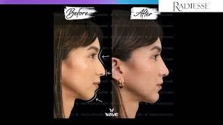 How to choose the best filler... Juvederm vs. Radiesse?  | Wave Plastic Surgery