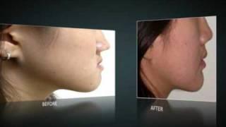 Why the long face? Amazing Makeover of a teenager with long face and protruding jaw.