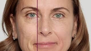 Sculptra Aesthetic provides natural, gradual rejuvenation to restore volume non-surgically.