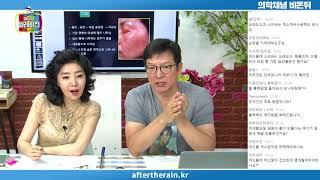 [메디텔] 여드름 흉터 치료법