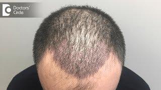 Is non surgical hair transplant permanent? - Dr. Nischal K