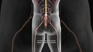 Is The Piriformis Entrapping Your Sciatic Nerve?